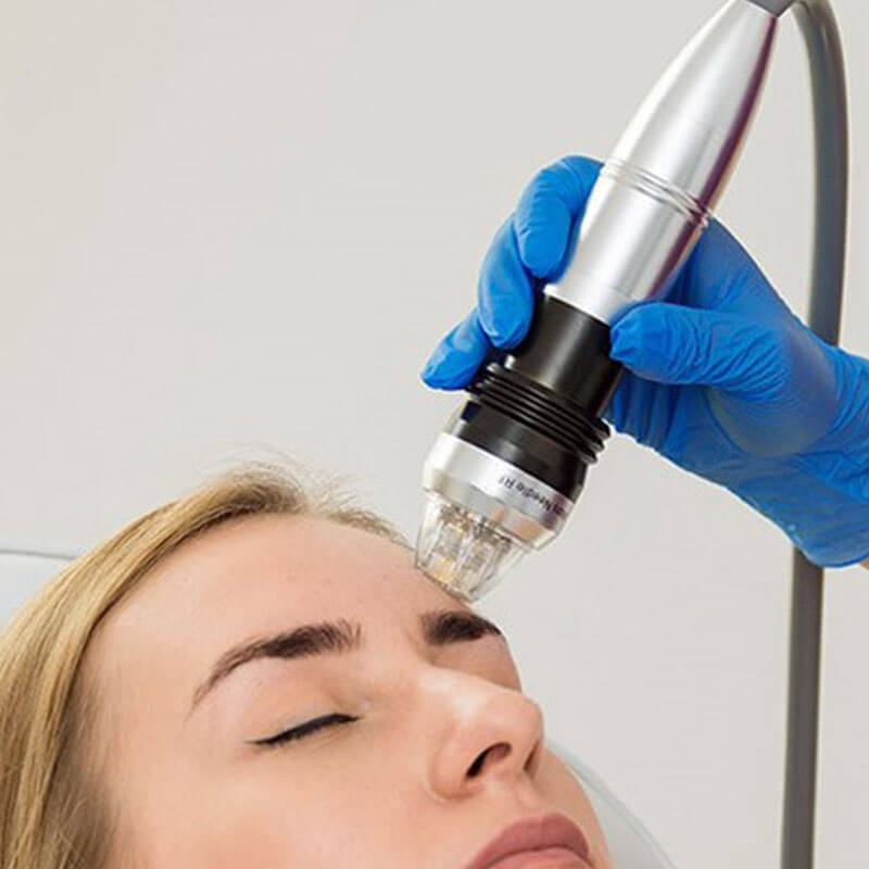 microneeding z radiofrekvenco